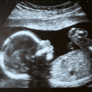 An ultrasound of a baby in profile